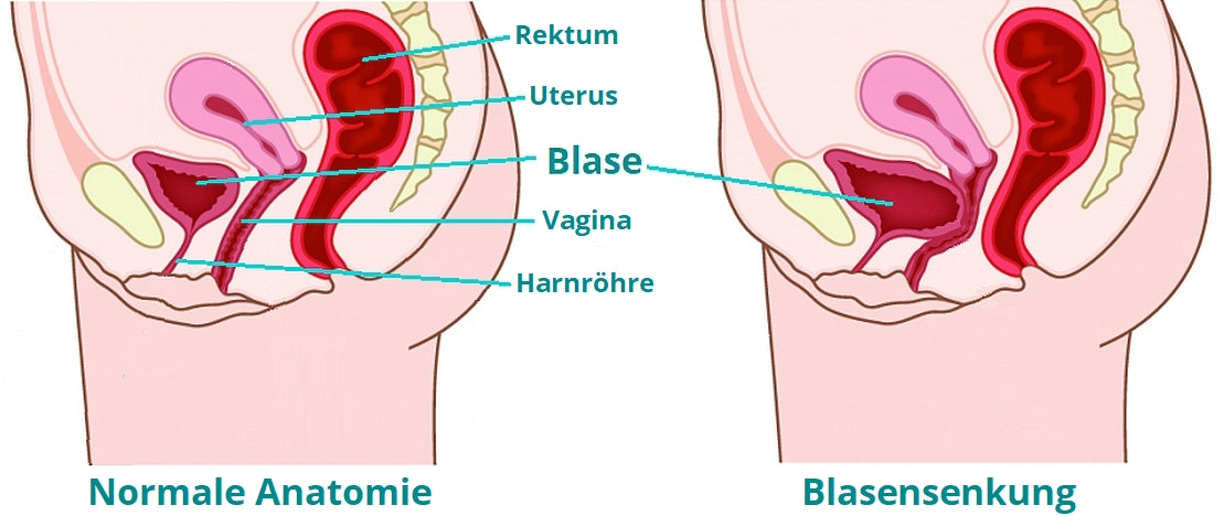 8 questions with answers in UTERINE PROLAPSE