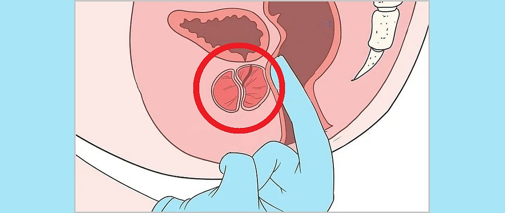 Prostatamassage richtig anwenden: Erfahre alles über Nutzen & Technik. ⮕  Schritt-für-Schritt-Anleitung zum sicheren Ausstreichen der Prostata