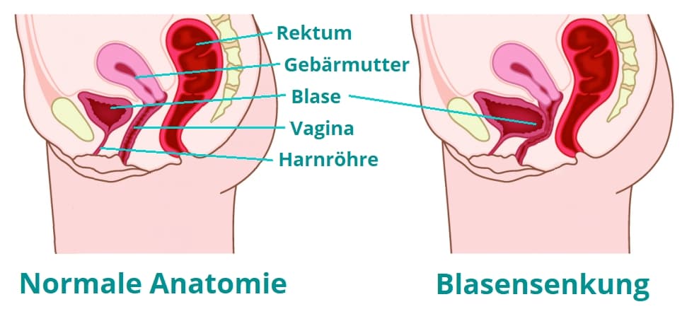 Blasensenkung: Symptome und Behandlungsoptionen