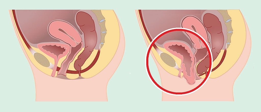 Disegno anatomico in sezione del bacino femminile con confronto tra un'anatomia normale e un cistocele (prolasso della vescica). Il cistocele sul lato destro dell'immagine è evidenziato da un cerchio rosso.